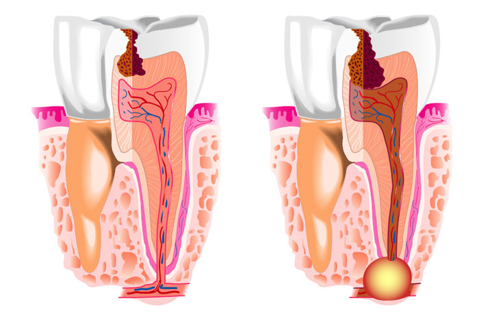 Caries, fracturas o desgaste dental
