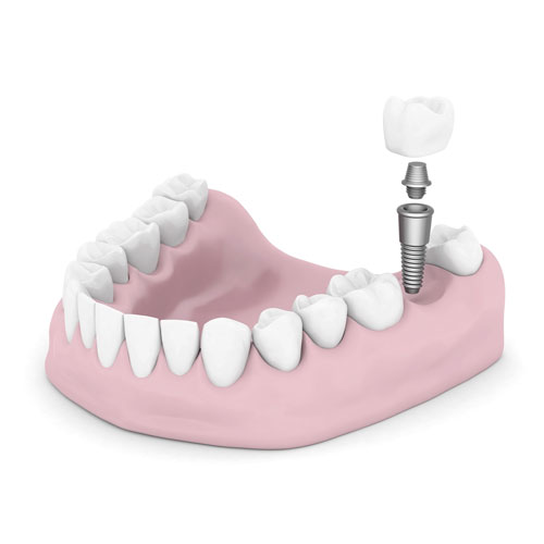 Implantes dentales de Titanio