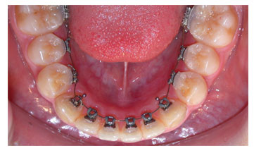 Características de la ortodoncia lingual