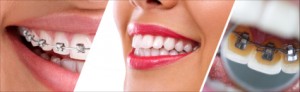 3 tipos de ortodoncia invisible