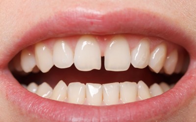 ¿Cómo juntar los dientes separados?