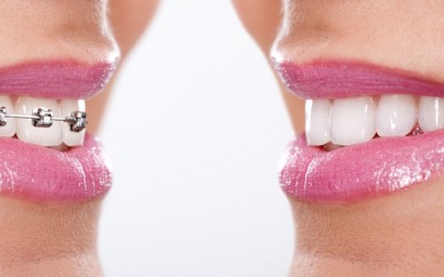 Tipos de ortodoncia que existen