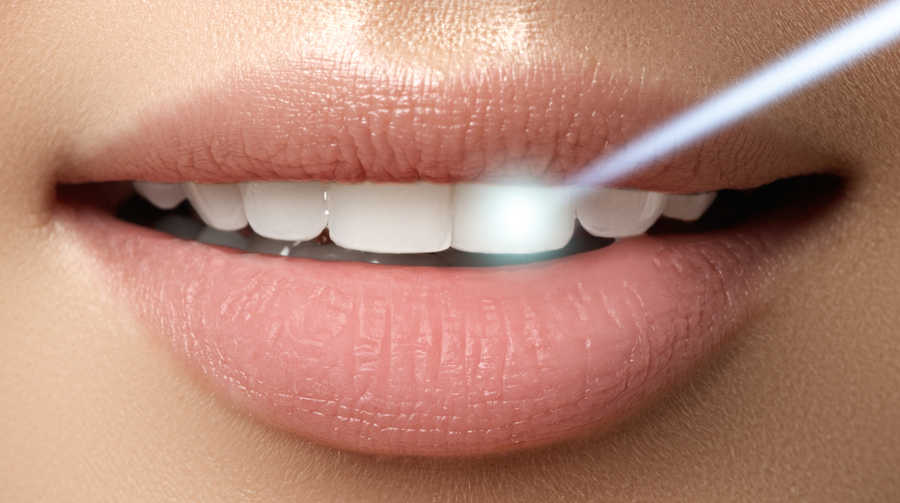 10 cosas que debes saber del blanqueamiento dental