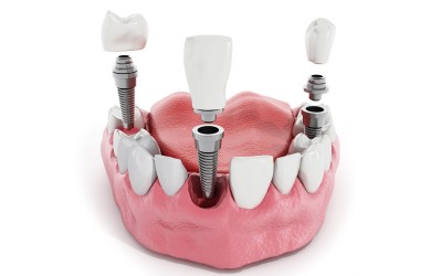 ¿Cuándo usar implantes dentales?