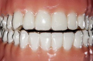ortodoncia invisalign sant cugat