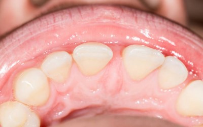 ¿Cómo afecta el frenillo labial y lingual en ortodoncia?