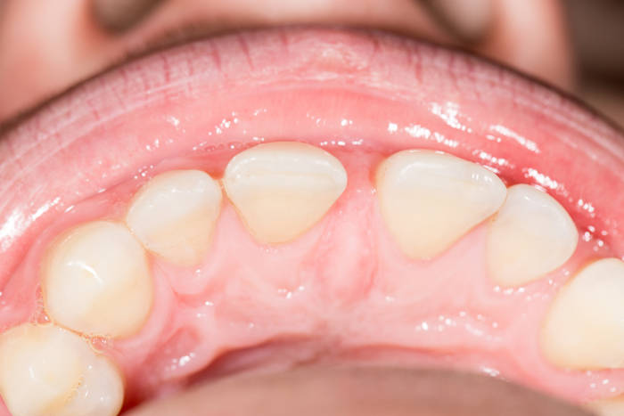 como afecta el frenillo en la ortodoncia