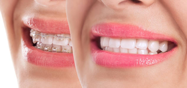 qué ortodoncia es mejor