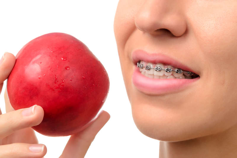 ¿Qué alimentos puedo comer con ortodoncia?