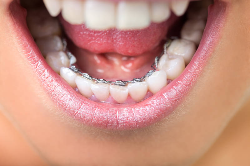 tipo ortodoncia