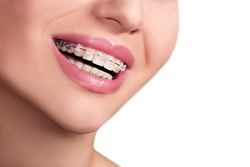 todo lo que debes saber sobre ortodoncia