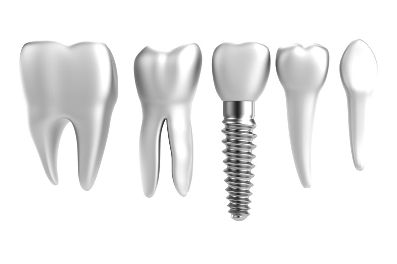 fracaso en implantes dentales