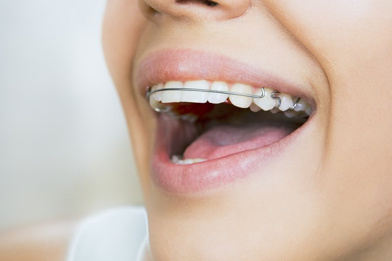 ¿Que es la ortodoncia preventiva, interceptada y correctiva?
