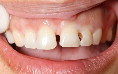 ¿Qué es la abrasión dental y cómo evitarla?