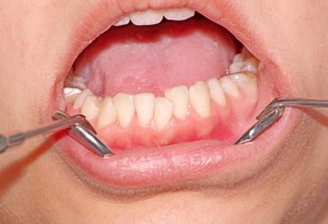 apiñamiento dental