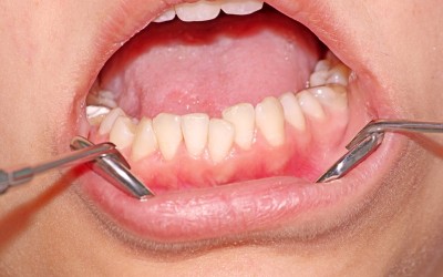 Apiñamiento dental: Qué es y como tratarlo